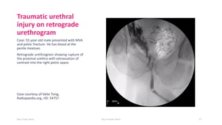 Retrograde Urethrogram Rupture Urology trauma , of Genito-Urinary tract .. | PDF