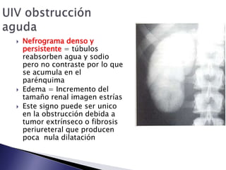  Nefrograma denso y
persistente = túbulos
reabsorben agua y sodio
pero no contraste por lo que
se acumula en el
parénquima
 Edema = Incremento del
tamaño renal imagen estrías
 Este signo puede ser unico
en la obstrucción debida a
tumor extrínseco o fibrosis
periureteral que producen
poca nula dilatación
 