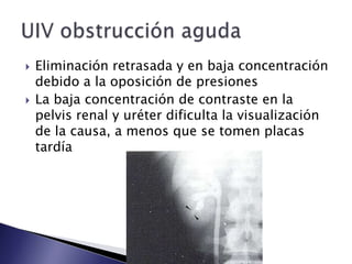  Eliminación retrasada y en baja concentración
debido a la oposición de presiones
 La baja concentración de contraste en la
pelvis renal y uréter dificulta la visualización
de la causa, a menos que se tomen placas
tardía
 