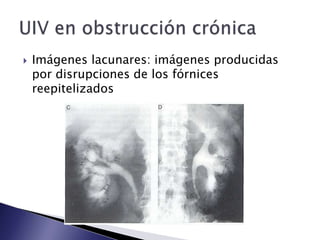  Imágenes lacunares: imágenes producidas
por disrupciones de los fórnices
reepitelizados
 