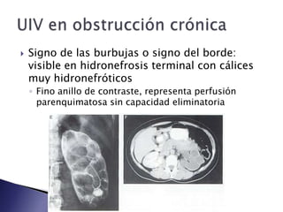  Signo de las burbujas o signo del borde:
visible en hidronefrosis terminal con cálices
muy hidronefróticos
◦ Fino anillo de contraste, representa perfusión
parenquimatosa sin capacidad eliminatoria
 