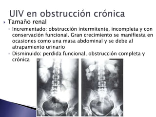  Tamaño renal
◦ Incrementado: obstrucción intermitente, incompleta y con
conservación funcional. Gran crecimiento se manifiesta en
ocasiones como una masa abdominal y se debe al
atrapamiento urinario
◦ Disminuido: perdida funcional, obstrucción completa y
crónica
 