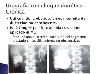  Util cuando la obstrucción es intermitente,
dilatación no concluyente.
 IV .25 mg/Kg de furosemida tras haber
aplicado el MC
◦ Produce una dilatación transitoria del segmento
afectado en las dilataciones no obstructivas
 