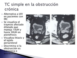  Alternativa a UIV
en pacientes con
IRC
 Se visualiza el
trayecto afectado
dilatado que
maneja 10UH y
hasta 30UH en
pionefrosis
 Visualiza litiasis y
el tejido
periureteral
 Discrimina si la
obstrucción es
intrínseca o
extrínseca
 