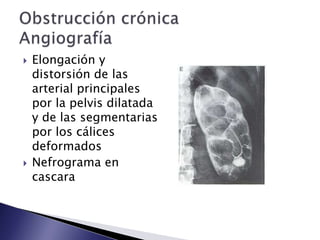  Elongación y
distorsión de las
arterial principales
por la pelvis dilatada
y de las segmentarias
por los cálices
deformados
 Nefrograma en
cascara
 
