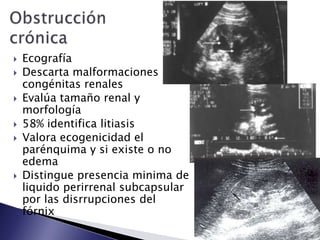  Ecografía
 Descarta malformaciones
congénitas renales
 Evalúa tamaño renal y
morfología
 58% identifica litiasis
 Valora ecogenicidad el
parénquima y si existe o no
edema
 Distingue presencia minima de
liquido perirrenal subcapsular
por las disrrupciones del
fórnix
 