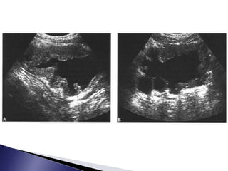 RADIOLOGIA DE LA UROPATIA OBSTRUCTIVA
