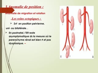 les uropathies malformatives congenitales | PPTX