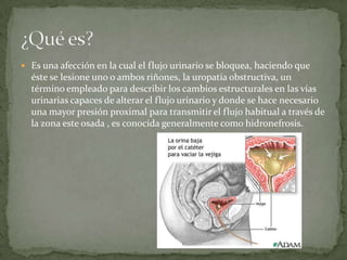  Es una afección en la cual el flujo urinario se bloquea, haciendo que
éste se lesione uno o ambos riñones, la uropatía obstructiva, un
término empleado para describir los cambios estructurales en las vías
urinarias capaces de alterar el flujo urinario y donde se hace necesario
una mayor presión proximal para transmitir el flujo habitual a través de
la zona este osada , es conocida generalmente como hidronefrosis.
 