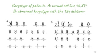 10
Karyotype of patient:- A: normal cell line 46,XY;
B: abnormal karyotype with the 18q deletion:-
A
 