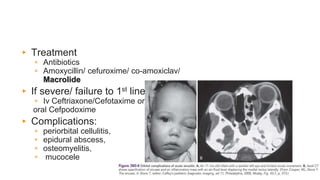 Sinusitis
▸ Treatment
▹ Antibiotics
▹ Amoxycillin/ cefuroxime/ co-amoxiclav/
Macrolide
▸ If severe/ failure to 1st line
▹ Iv Ceftriaxone/Cefotaxime or
oral Cefpodoxime
▸ Complications:
▹ periorbital cellulitis,
▹ epidural abscess,
▹ osteomyelitis,
▹ mucocele
 
