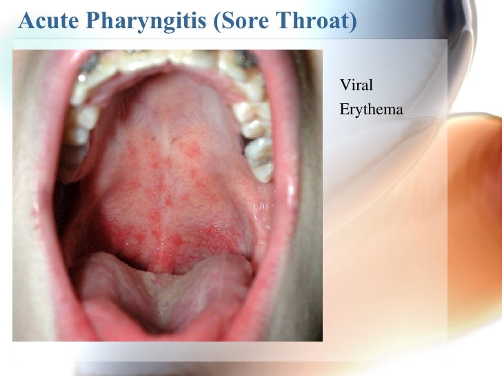 Acute Pharyngitis Natural Treatment Acute Pharyngitis Natural Treatment