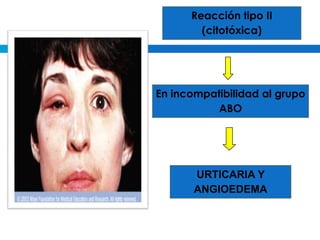 Reacción tipo II
        (citotóxica)




En incompatibilidad al grupo
           ABO




       URTICARIA Y
       ANGIOEDEMA
 