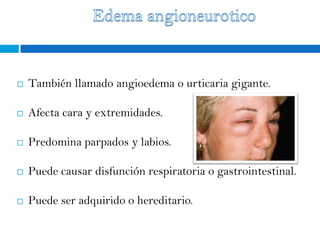    También llamado angioedema o urticaria gigante.

   Afecta cara y extremidades.

   Predomina parpados y labios.

   Puede causar disfunción respiratoria o gastrointestinal.

   Puede ser adquirido o hereditario.
 