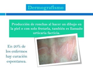Producción de ronchas al hacer un dibujo en
  la piel o con solo frotarla, también es llamado
                 urticaria facticia.


 En 20% de
los enfermos
hay curación
 espontanea.
 