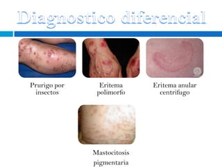 Prurigo por     Eritema      Eritema anular
 insectos      polimorfo       centrifugo




              Mastocitosis
              pigmentaria
 
