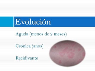 Aguda (menos de 2 meses)

Crónica (años)

Recidivante
 
