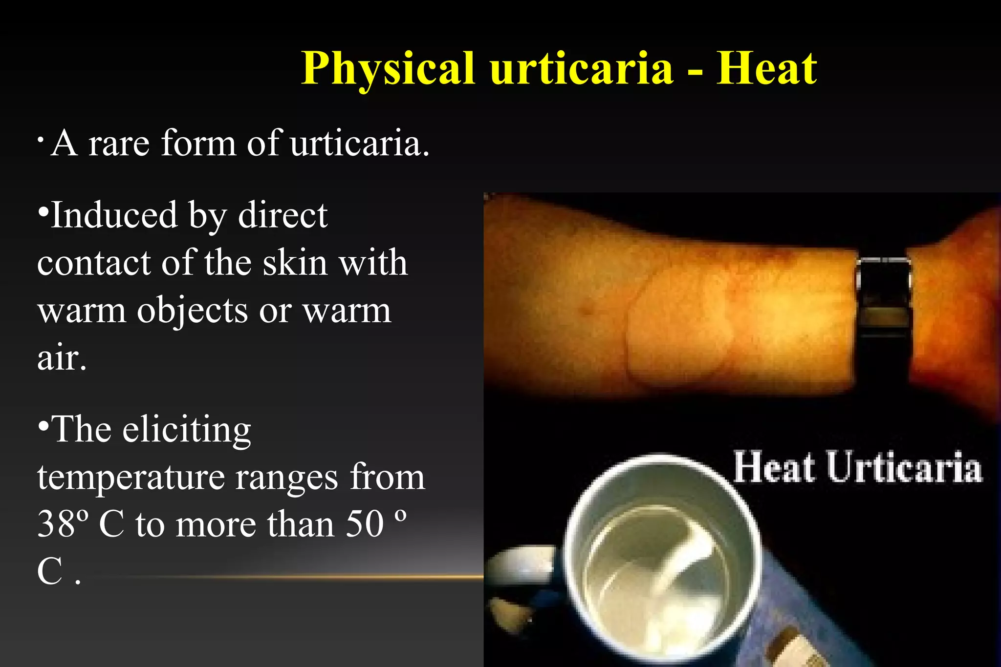Urticaria | PPT