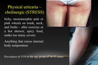 Itchy, monomorphic pale or
pink wheals on trunk, neck,
and limbs – after exercise or
a hot shower, spicy food,
under too many covers.
Anything that raises internal
body temperature
Physical urticaria –
cholinergic (STRESS)
Prevalence of 11% in the age group of 16-35 years.
 