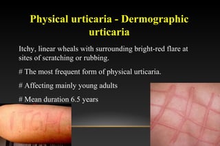 Physical urticaria - Dermographic
urticaria
Itchy, linear wheals with surrounding bright-red flare at
sites of scratching or rubbing.
# The most frequent form of physical urticaria.
# Affecting mainly young adults
# Mean duration 6.5 years
 