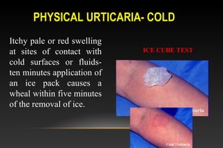 PHYSICAL URTICARIA- COLD
Itchy pale or red swelling
at sites of contact with
cold surfaces or fluids-
ten minutes application of
an ice pack causes a
wheal within five minutes
of the removal of ice.
ICE CUBE TEST
 