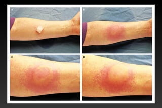 •More frequent in women than men.
•Majority is idiopathic, some can also occur as a result of
infections, neoplasia or autoimmune diseases.
•Infectious: syphilis, measles hepatitis ,mononucleosis, HIV.
 