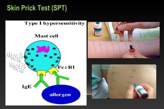 Skin Prick Test (SPT)
 