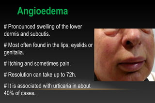 # Pronounced swelling of the lower 
dermis and subcutis.
# Most often found in the lips, eyelids or 
genitalia.
# Itching and sometimes pain.
# Resolution can take up to 72h.
# It is associated with urticaria in about 
40% of cases.
Angioedema
 