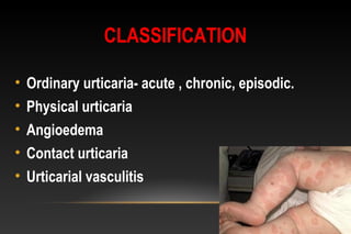 CLASSIFICATION
• Ordinary urticaria- acute , chronic, episodic.
• Physical urticaria
• Angioedema
• Contact urticaria
• Urticarial vasculitis
 