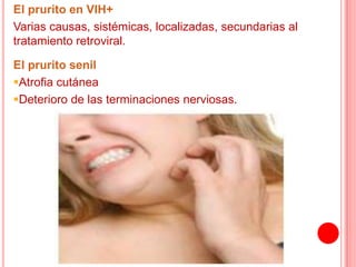 El prurito en VIH+
Varias causas, sistémicas, localizadas, secundarias al
tratamiento retroviral.
El prurito senil
Atrofia cutánea
Deterioro de las terminaciones nerviosas.
 