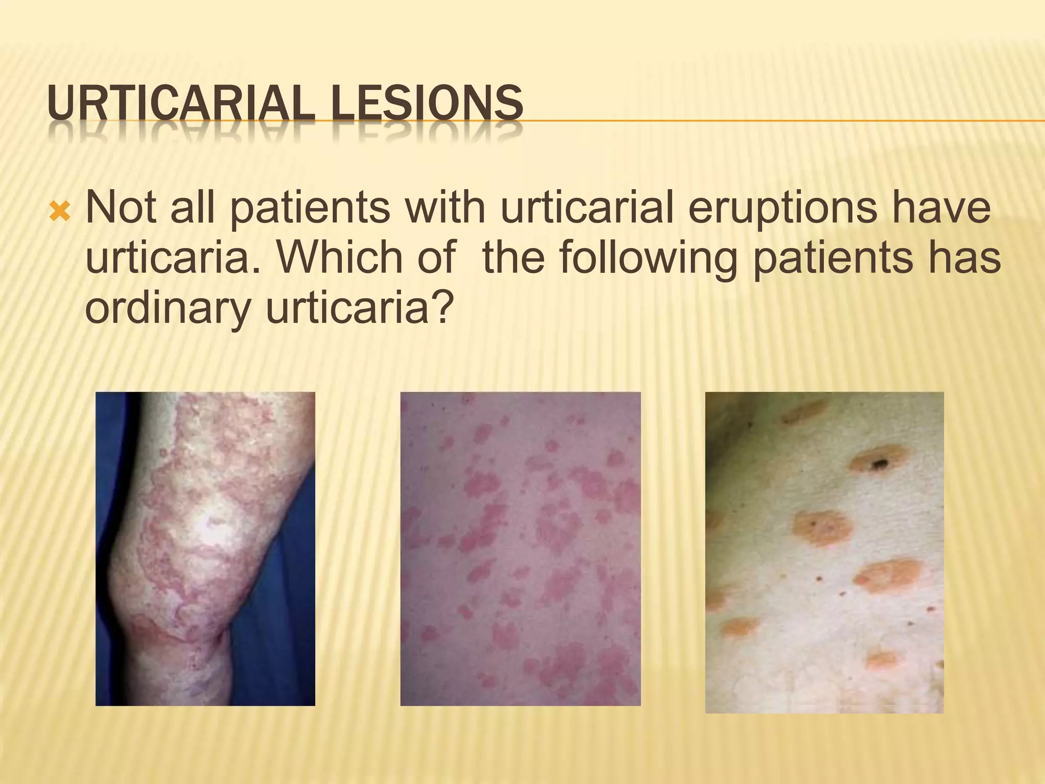 Urtricarial Rrash Urticaria | PPTX