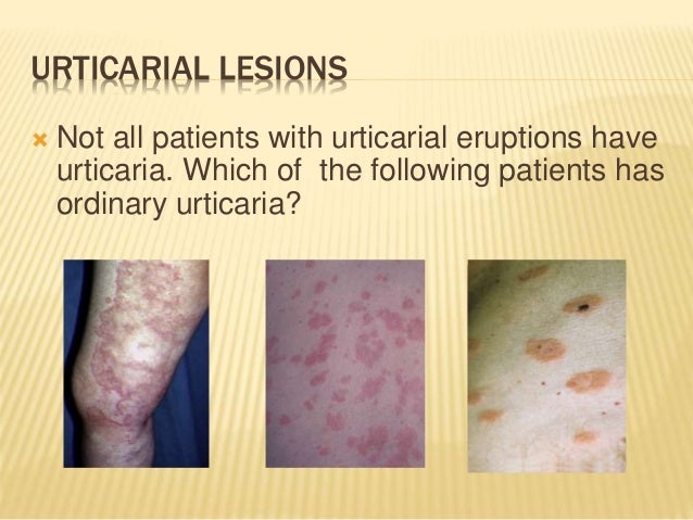 Solumedrol Fda Prescribing Information Side Effects And Uses Solumedrol Fda Prescribing Information Side Effects And Uses