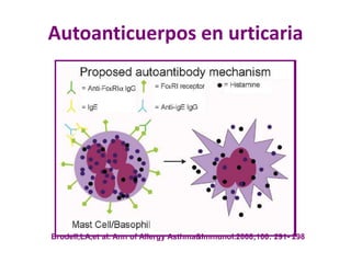 Autoanticuerpos en urticaria
Brodell,LA,et al. Ann of Allergy Asthma&Immunol.2008;100: 291- 298
 