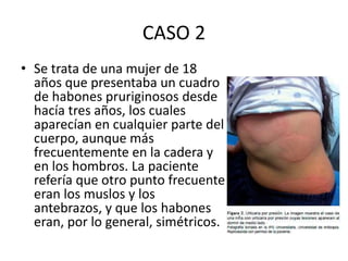 CASO 2
• Se trata de una mujer de 18
años que presentaba un cuadro
de habones pruriginosos desde
hacía tres años, los cuales
aparecían en cualquier parte del
cuerpo, aunque más
frecuentemente en la cadera y
en los hombros. La paciente
refería que otro punto frecuente
eran los muslos y los
antebrazos, y que los habones
eran, por lo general, simétricos.
 
