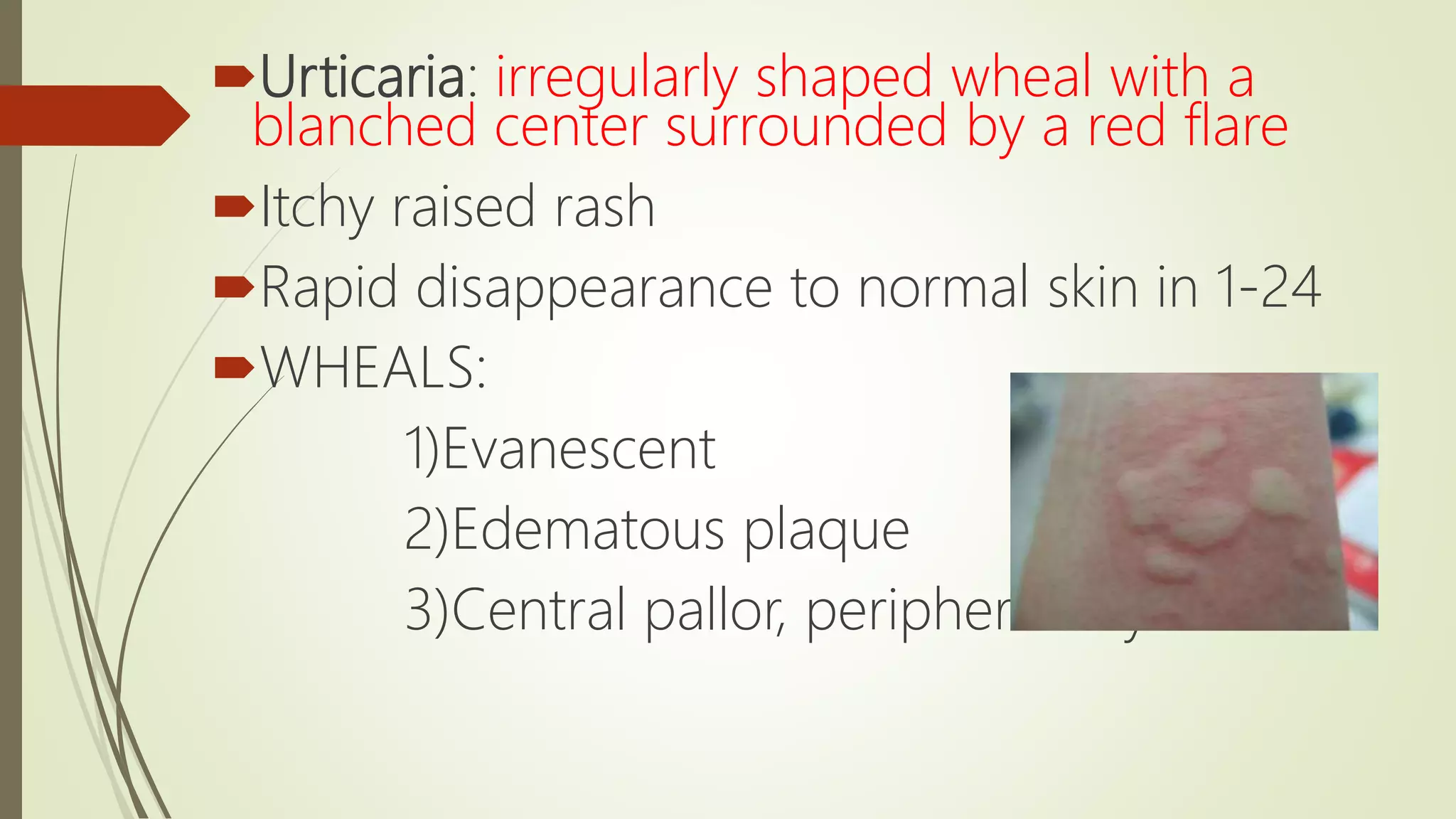 Urticaria | PPTX