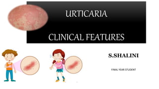 URTICARIA
CLINICAL FEATURES
S.SHALINI
FINAL YEAR STUDENT
 