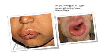 Pale , pink , swelling of the lips . May be
associated with swelling of tongue ,
pharynx and larynx .
 