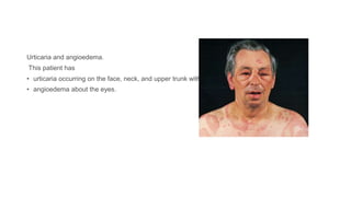 Urticaria and angioedema.
This patient has
• urticaria occurring on the face, neck, and upper trunk with
• angioedema about the eyes.
 