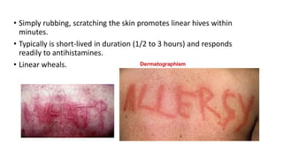 • Simply rubbing, scratching the skin promotes linear hives within
minutes.
• Typically is short-lived in duration (1/2 to 3 hours) and responds
readily to antihistamines.
• Linear wheals.
 