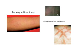 Linear wheals at sites of scratching
Dermographic urticaria
 