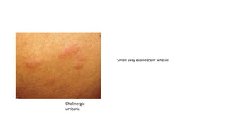 Small very evanescent wheals
Cholinergic
urticaria
 