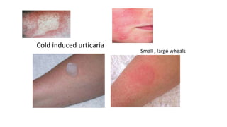 Small , large wheals
Cold induced urticaria
 