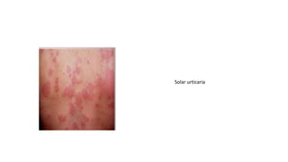 Solar urticaria
 