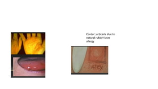 Contact urticaria due to
natural rubber latex
allergy
 