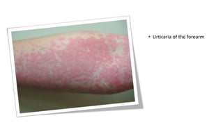 • Urticaria of the forearm
 