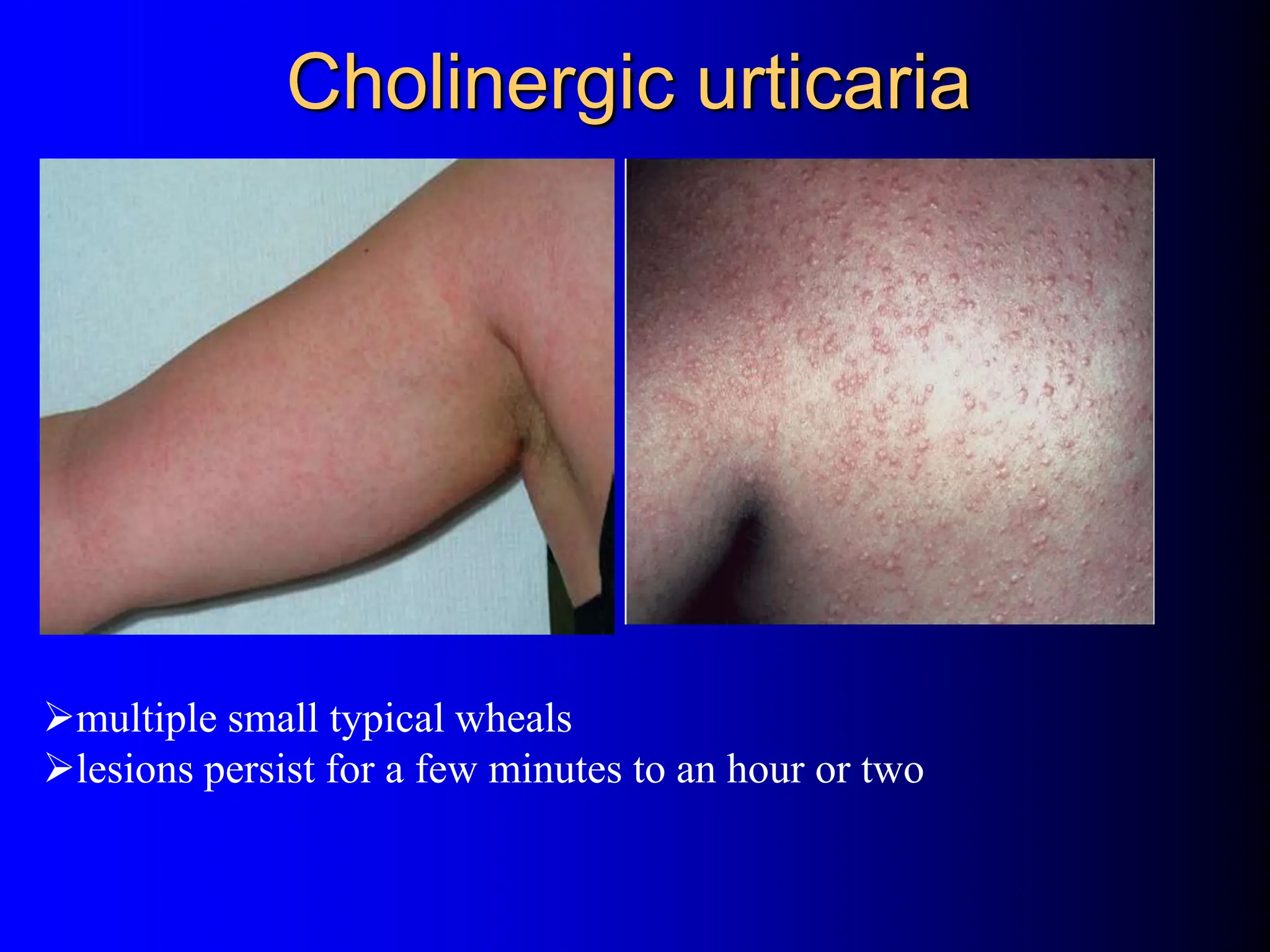 Cholinergic Rash urticaria.ppt Dermatology Skin conditions Allergy | PPT