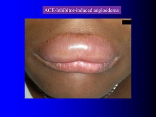 urticaria.ppt Dermatology Skin conditions Allergy | PPT