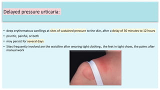 Urticaria ,types and management bolognia .pptx