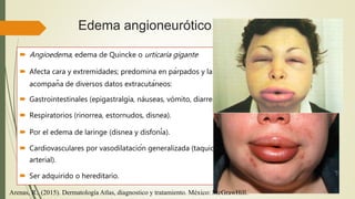 Urticaria. Dermatologia. | PPT