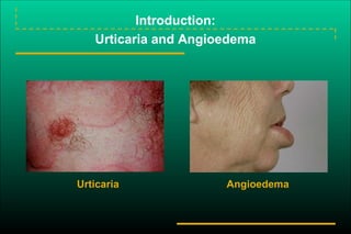 Introduction:
Urticaria and Angioedema
Urticaria Angioedema
 